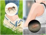 以Identify Insect Bites Step 1为标题的图片
