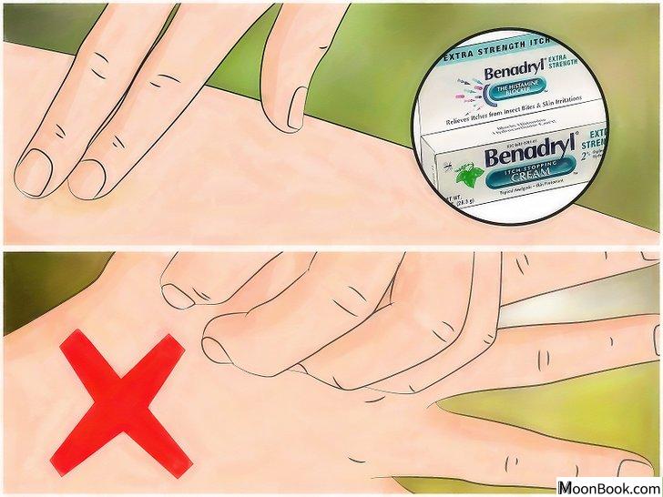 以Identify Insect Bites Step 10为标题的图片