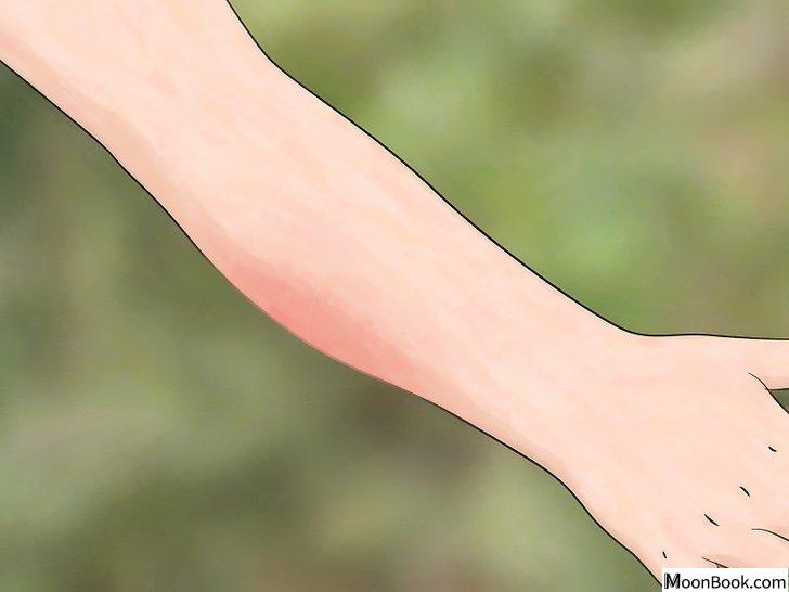 以Identify Insect Bites Step 3为标题的图片