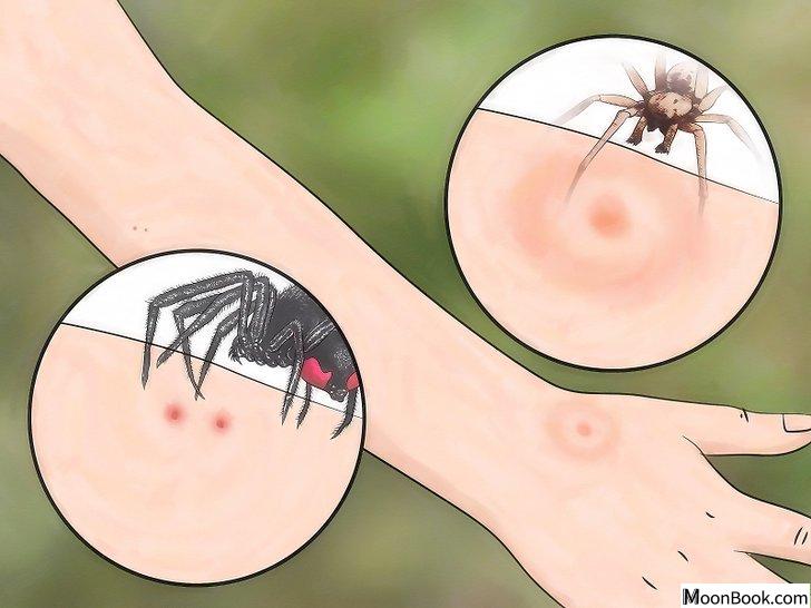 以Identify Insect Bites Step 7为标题的图片