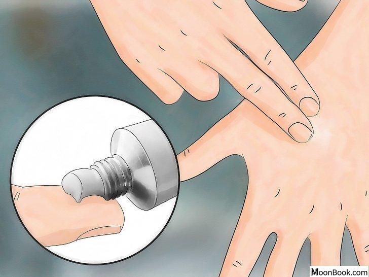 以Reduce the Pain of Gnat Bites Step 5为标题的图片
