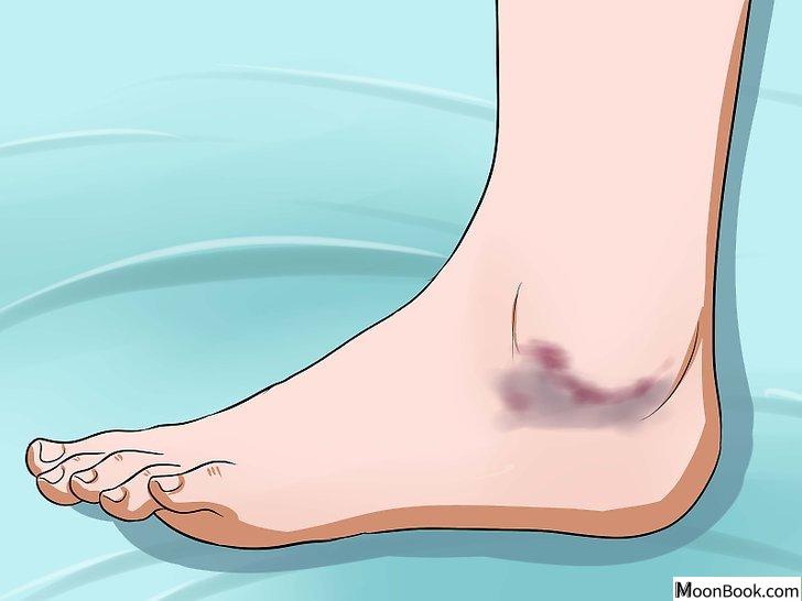 以Soothe a Sore Ankle Step 2为标题的图片