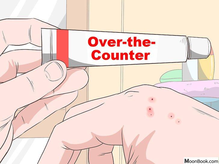 以Stop Mosquito Bites from Itching Step 7为标题的图片