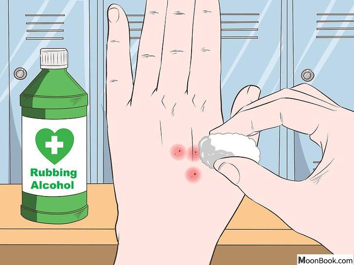 以Stop Mosquito Bites from Itching Step 9为标题的图片